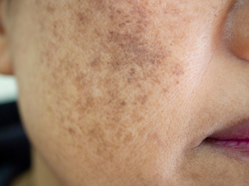 melasma