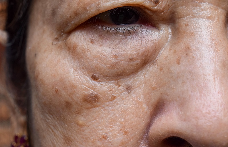 age spots on a face of old lady