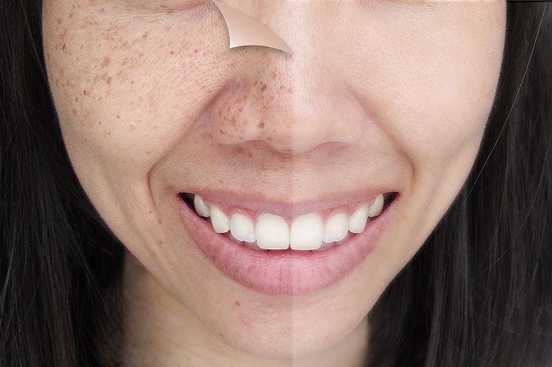 how to remove age spots and freckles