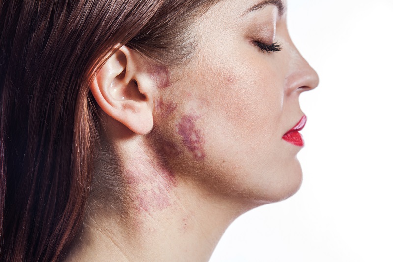 birthmark on the neck