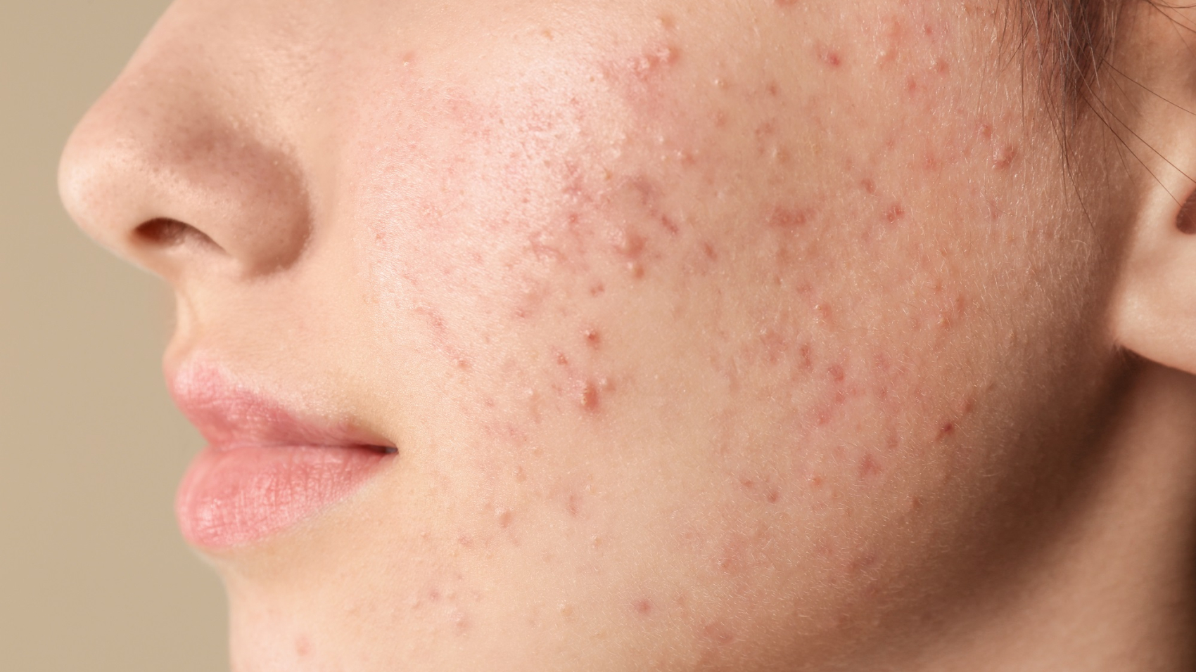 Teenage,Girl,With,Acne,Problem,On,Beige,Background,,Closeup